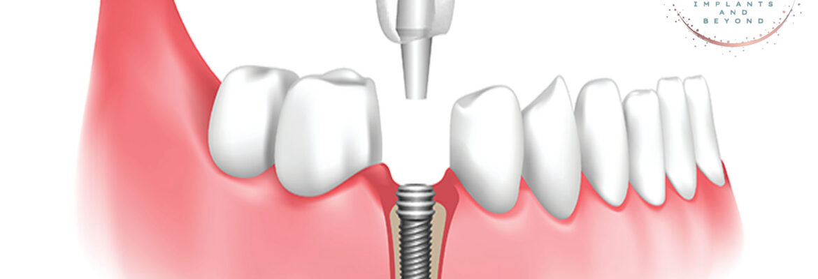 All on 4 Dental Implants Myths Unveiled: Busting Misconceptions